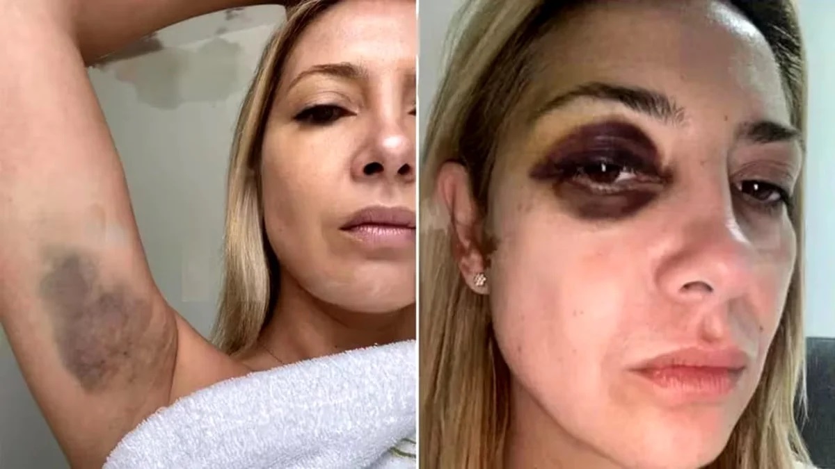 La ex primera dama se tomó imágenes frente a un espejo con un ojo negro y moretones en sus brazos