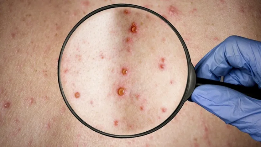Medidas para prevenir la viruela del mono